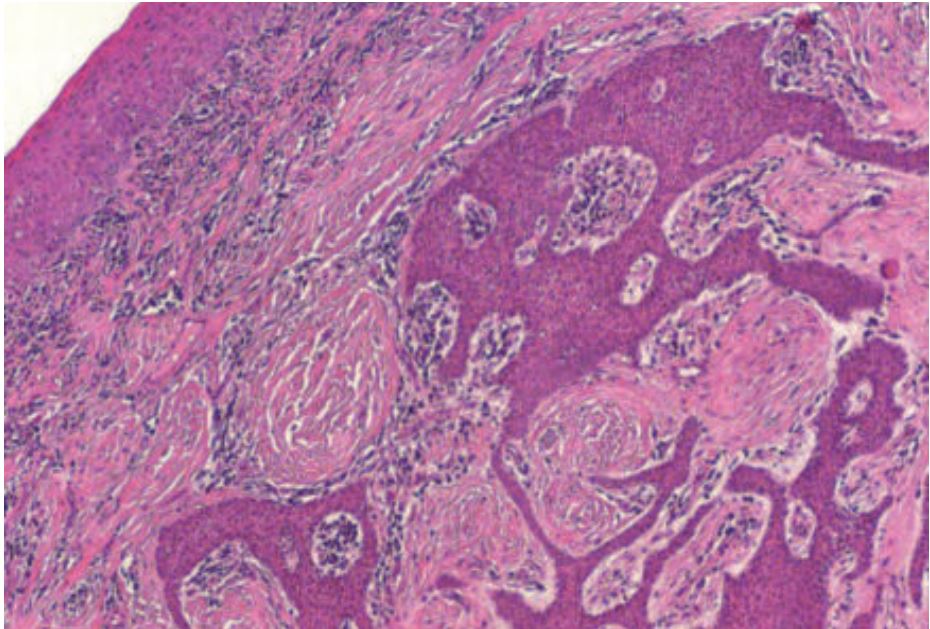 Laboklin: Canine Acanthomatous Ameloblastoma with its odontogenic epithelia in the submucosa, HE,Obj x20