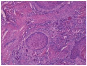 Laboklin: Infiltrative growth of a squamous cell carcinoma in a giant schnauzer (HE 10x).