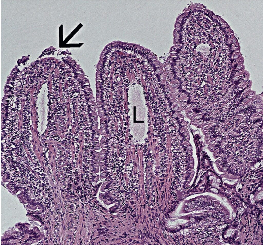 Laboklin: Histological lesions in a case of LPE (arrow points to epithelial lesion, L = mild lymphangiectases), HE 100x