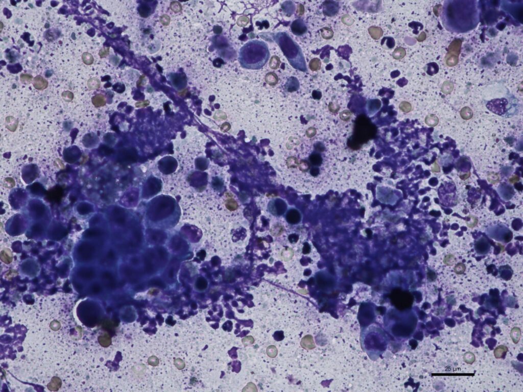 Laboklin: Cytological picture of prostate carcinoma with prostatitis: numerous partly degenerated neutrophil granulocytes and clusters of pleomorphic prostate epithelial cells with large, differently shaped cell nuclei (Haema Quick Stain, bar = 25 µm)