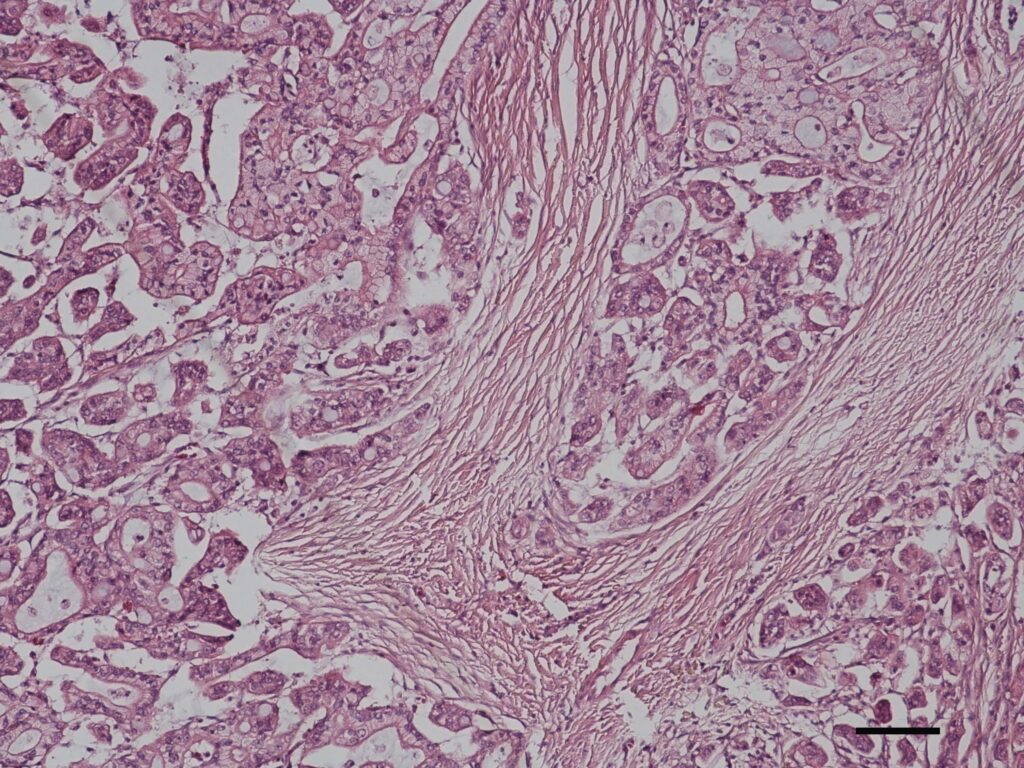 Laboklin: Histological picture of a highly aggressive, tubulopapillary prostate carcinoma with infiltrative growth (Gleason Pattern 3, score sum 8, bar = 100 µm)