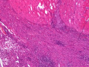 Laboklin: High-grade chronic histiocytic to mixed-cell colitis in a Boxer (haematoxylin-eosin stain, 4x).