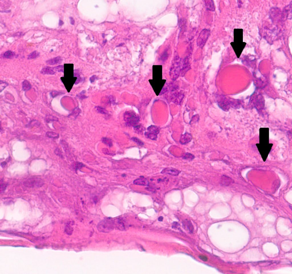 Laboklin: Skin biopsy. Detection of keratinocytes with intranuclear eosinophilic inclusion bodies (arrows). 40x HE. 