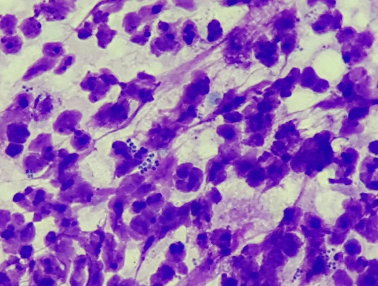 Laboklin: Pyoderma; in addition to numerous degenerated neutrophils, intracellular cocci are also seen