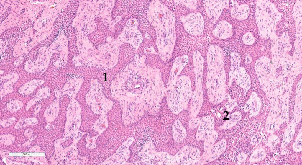 Laboklin: Histological picture of a CAA, dog. 1) Predominant odontogenic epithelium. 2) Early intraepithelial cyst formation. HE stain, 10x obj.