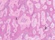 Laboklin: Histological picture of a CAA, dog. 1) Predominant odontogenic epithelium. 2) Early intraepithelial cyst formation. HE stain, 10x obj.