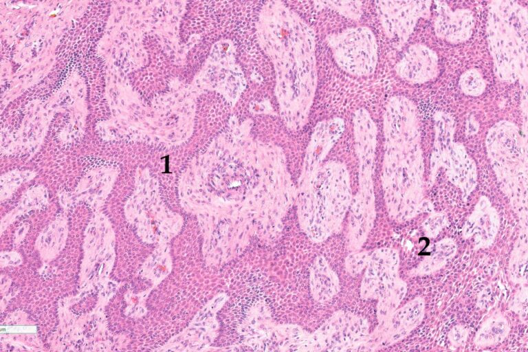 Laboklin: Histological picture of a CAA, dog. 1) Predominant odontogenic epithelium. 2) Early intraepithelial cyst formation. HE stain, 10x obj.