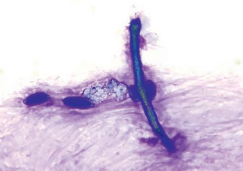 Laboklin: Elongated, double-walled fungal hypha and 4 pollen grains. Rapid romanowsky-type staining