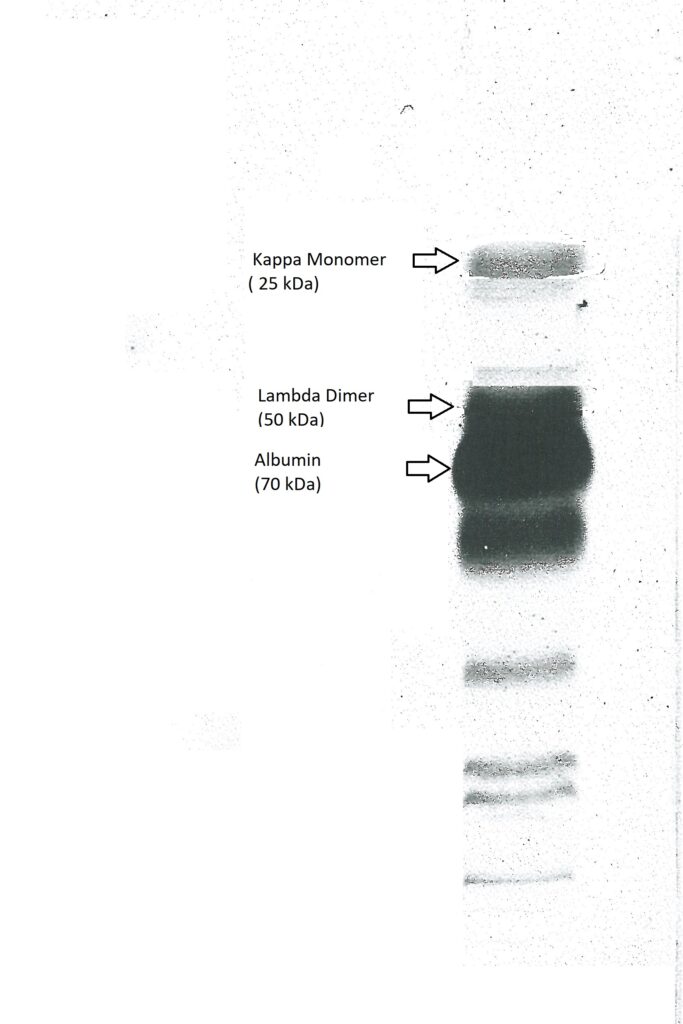 Laboklin: Urine electrophoresis of a cat (7 years) with multiple myeloma: The patterns of kappa monomers and lambda dimers can be seen. Due to the advanced renal damage, albumin and glomerular proteins can also be detected.