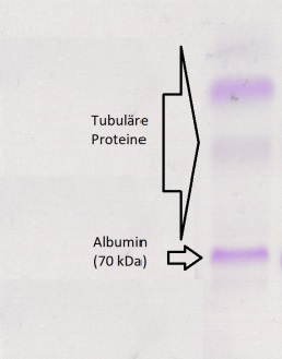 Laboklin: Urine electrophoresis of a Miniature Bull Terrier (6 months) with Fanconi syndrome caused by toxicity: Albumin and tubular proteins only can be detected.