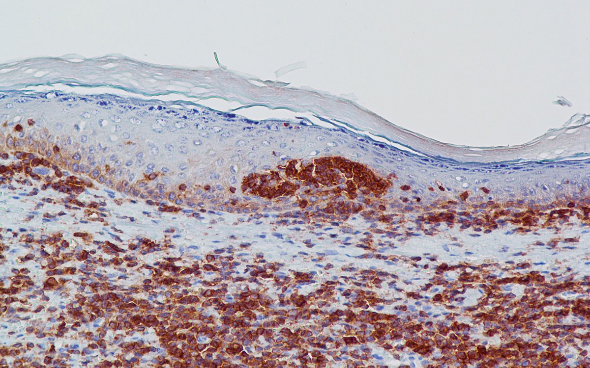 Laboklin: Guinea pig: skin, epitheliotropic T-cell lymphoma, immunohistochemistry with positive reaction for CD3 (T-cell lymphocyte) marker  