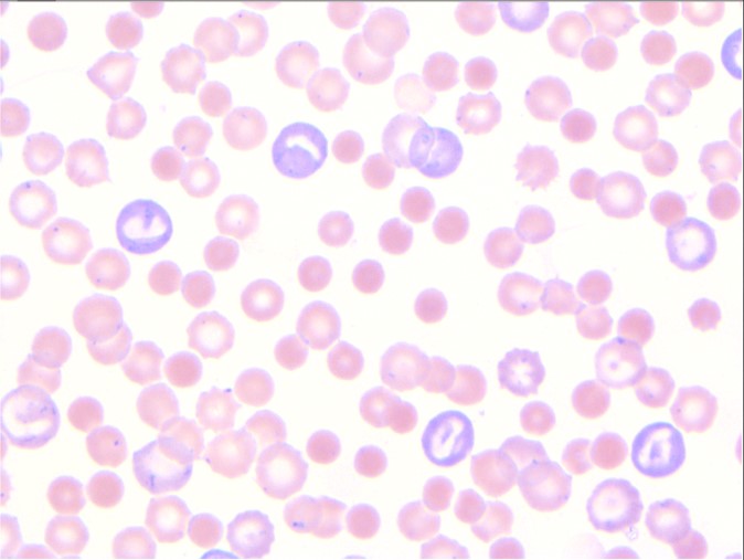 Laboklin: Blood smear from a dog with IMHA showing spherocytes, anisocytosis and polychromasia.