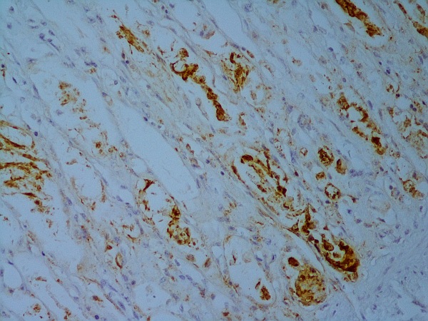 Laboklin: Small intestine: marked villous atrophy and fusion with necrosis of the crypt epithelium (HE stain)
