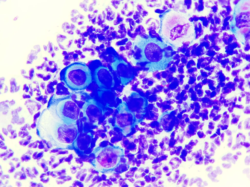 Cytological picture of pemphigus foliaceus (PF):
there are aggregates of neutrophilic granulocytes, in which some acantholytic cells are embedded.