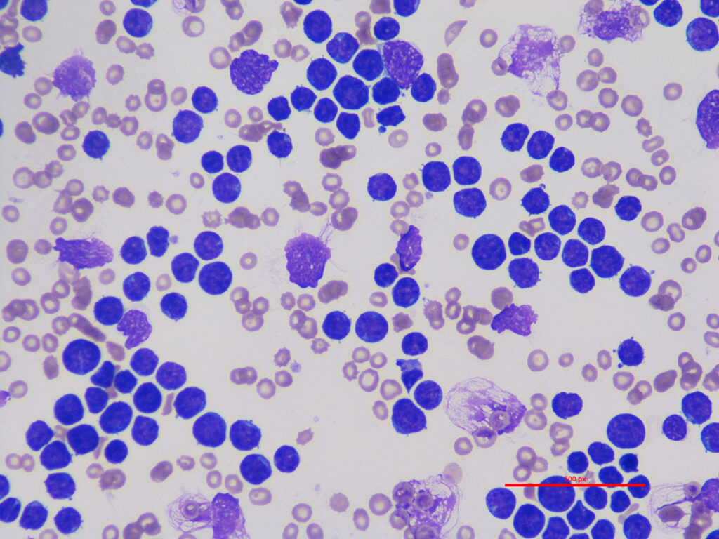 Leucemia linfatica, cane. Colorazione Wright-Giemsa, ingrandimento 500x con olio da immersione.