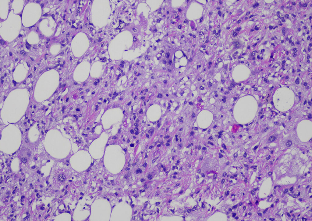 Liposarcoma (colorazione HE, ingrandimento 100x)