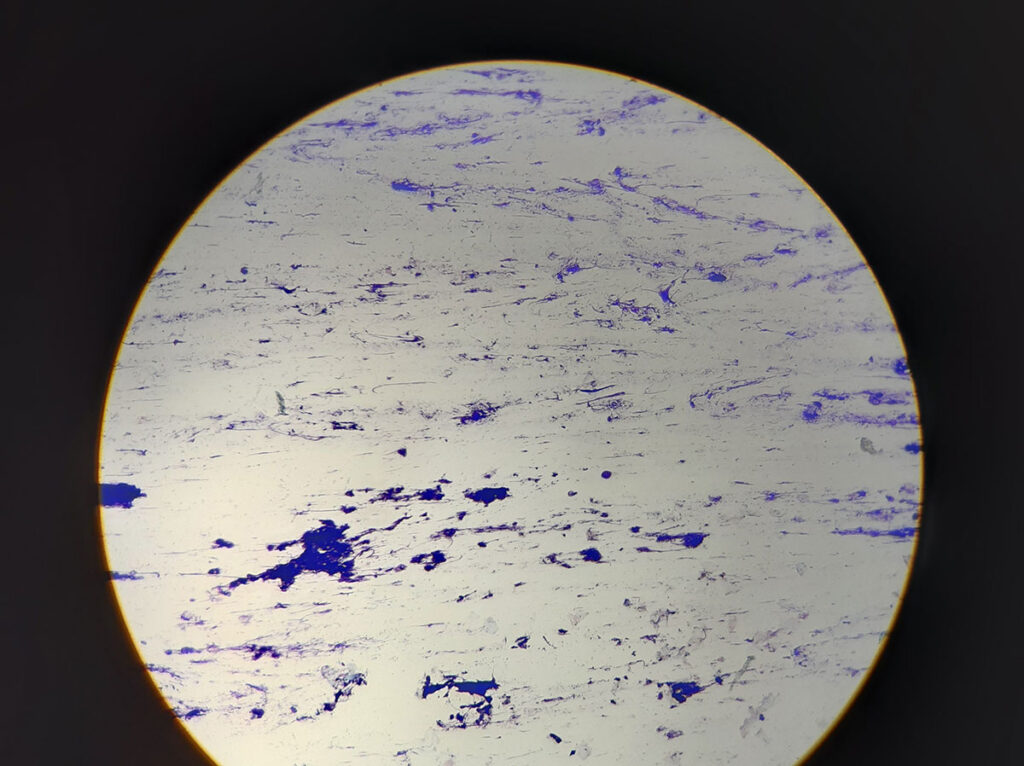 Immagine microscopica di un tampone auricolare di un coniglio con otite esterna che mostra striature di DNA chiaramente colorate, cheratinociti e neutrofili e cocchi sparsi (ingrandimento 100x, Diff-Quick®)