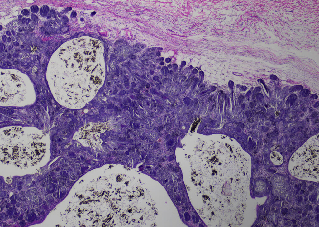 Tricofolliculoma (colorazione HE, ingrandimento 20x)