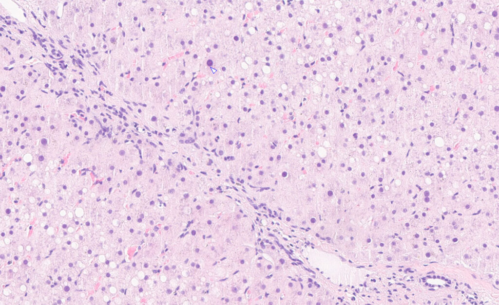Liver biopsy of a horse with long-term exposure to mycotoxins and suspected poisonous plants: mild to moderate fibrosis.