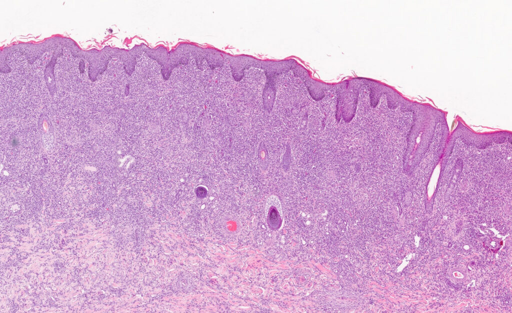 Histological section of a diffuse granulomatous inflammation, H&E stain, 20× magnification