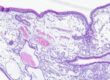 Histology of a nasal polyp in a dog, 4× magnification, H&E stain