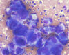 Pleomorphic cells of a carcinoma
