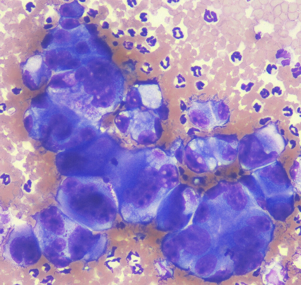 Pleomorphic cells of a carcinoma