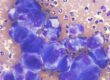 Pleomorphic cells of a carcinoma