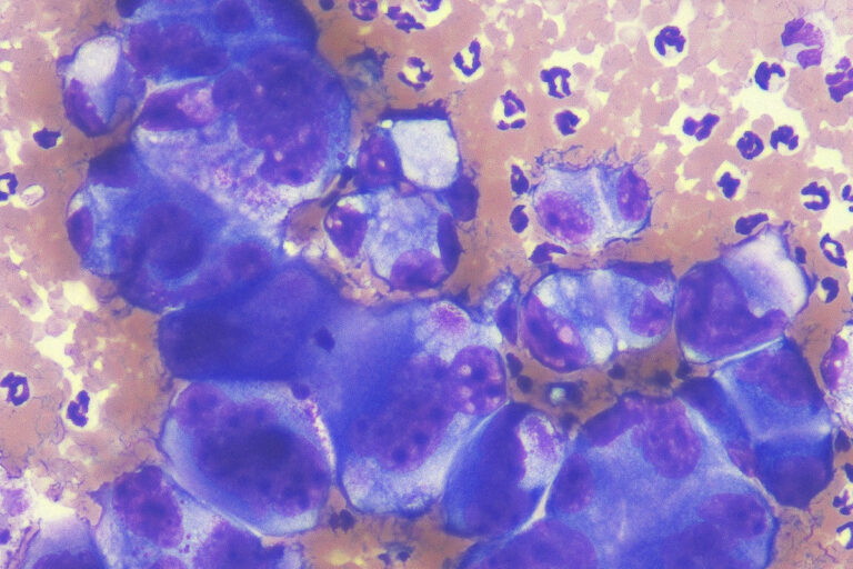 Pleomorphic cells of a carcinoma