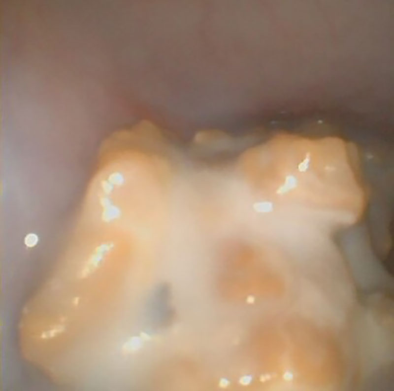 Rhinoscopic image of a fungal plaque in a dog