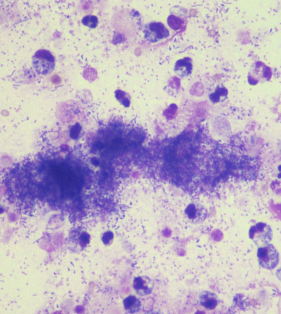 septic effusion; Diff-Quick stain, 400× magnification